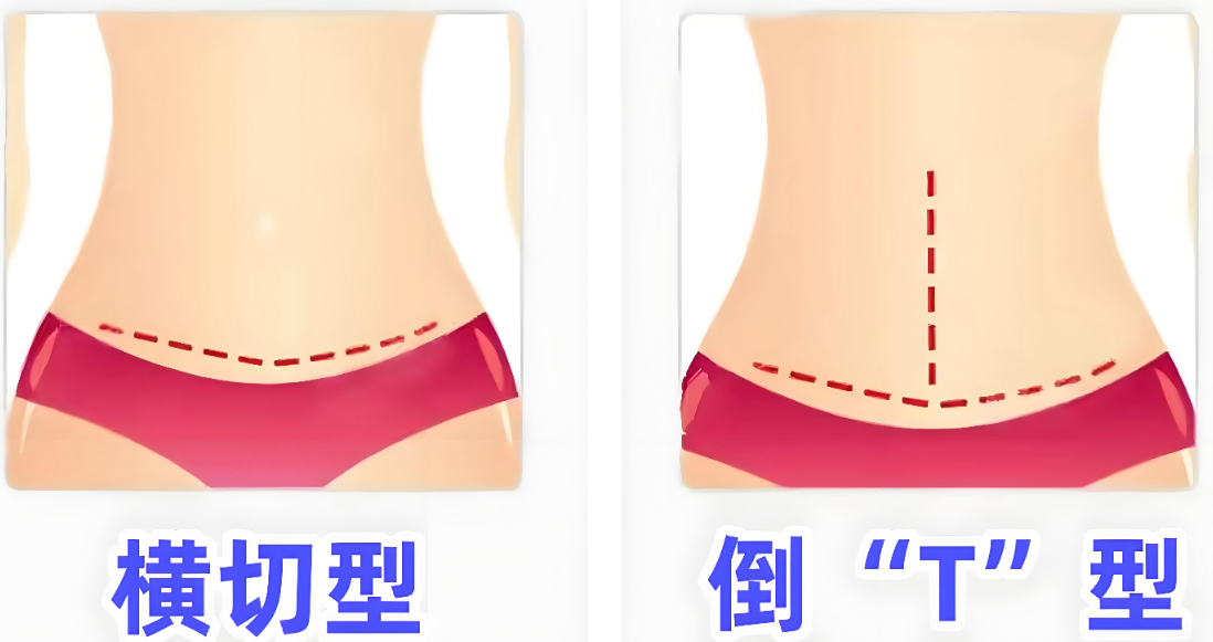 上海腹壁整形手术医生排名top5一览，真实口碑里，这些医生被反复提到