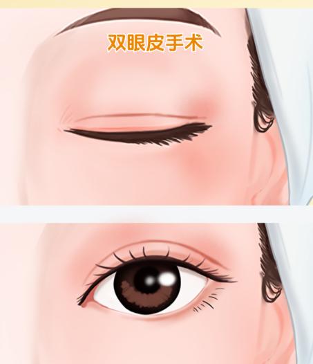 廈門海峽張宏vs王明陽眼修復(fù)對比，兩位20年經(jīng)驗(yàn)的醫(yī)生怎么選才靠譜