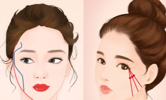 花5w做的颧骨颧弓内推，鼻子显高效果比我想象中明显