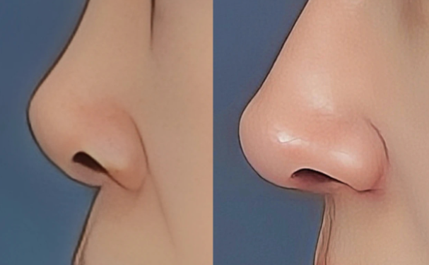 三、杨杰鼻翼缩小的术后护理与变好攻略