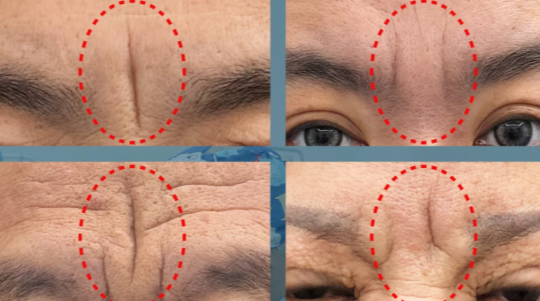 无锡花柒子医疗美容可以切川字纹吗？重度川字纹也能做微创切除！附成效对比图