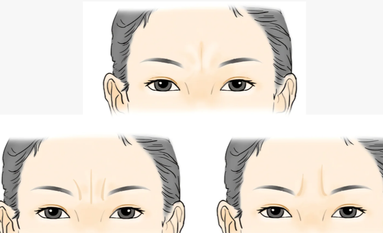 无锡花柒子医疗美容切川字纹的价格与影响因素