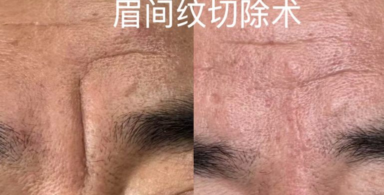 无锡花柒子医疗美容切川字纹的技术特点与用户反馈