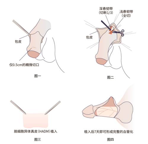 吕巍院长男科手术疼不疼？2025新版10位患者真实反馈，7天修复记录公开