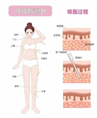 2. 赣州华美医疗美容医院：水动力吸脂，变好更快