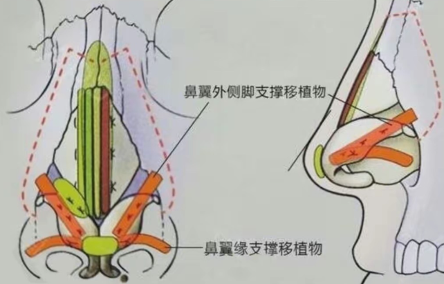 五、三种鼻翼缘修复方案详细对比，看看你适合哪种