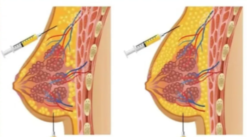 四、总结：为什么选择江华医生做隆胸？