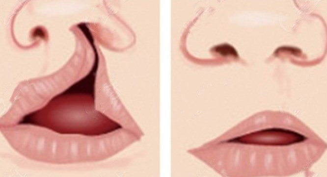 五、从特殊情况处理看：舒茂国做唇裂多大岁数能做手术？www.aimei.com