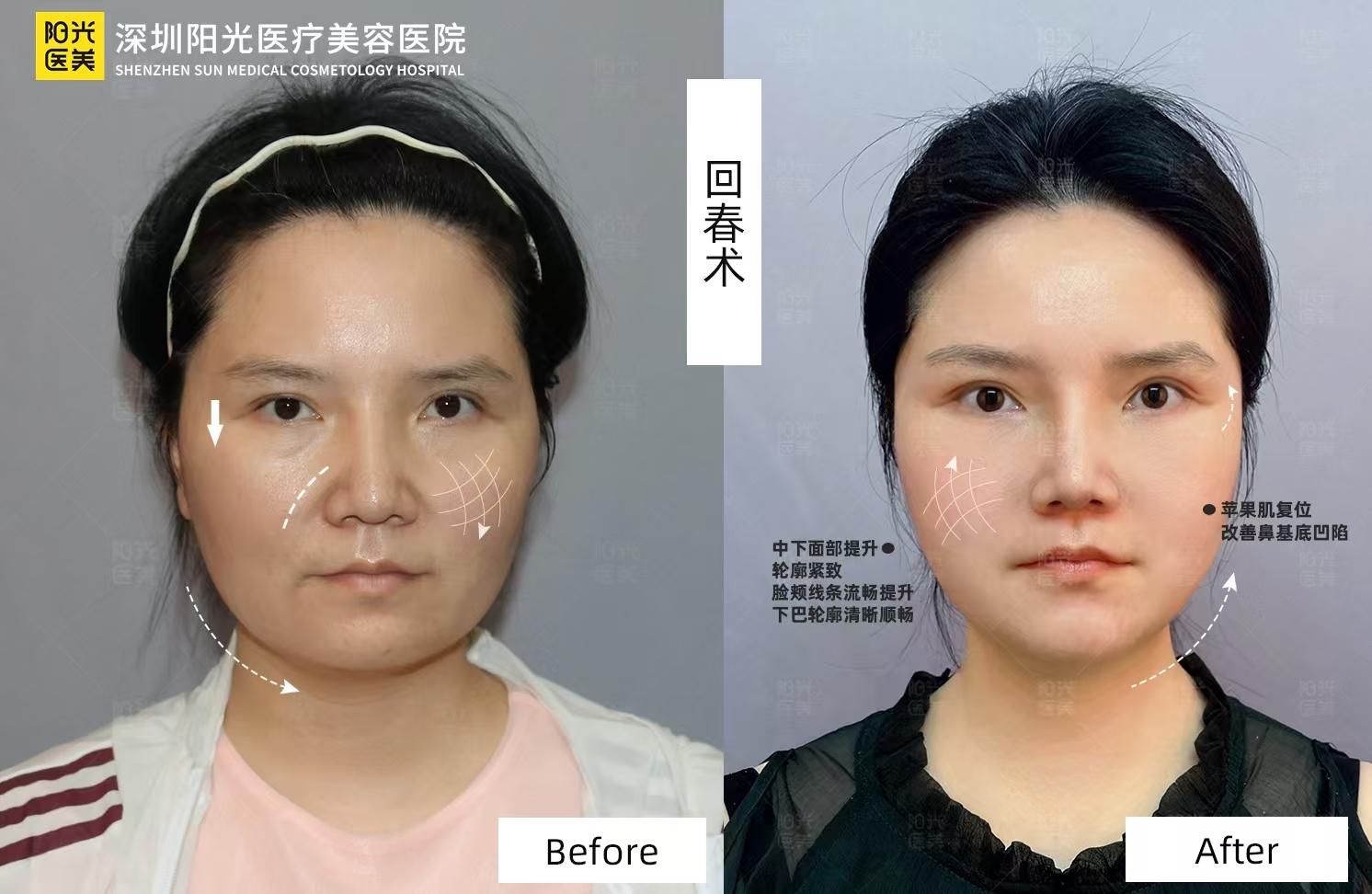 趙鵬筋膜提升價格同手術方式大公開！手術費由3萬起，同張路比邊個更抵