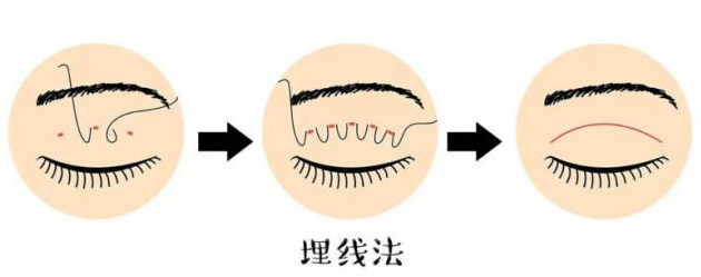 三、北京胡彬医生双眼皮就诊攻略：挂号时间、医生坐诊安排www.aimei.com