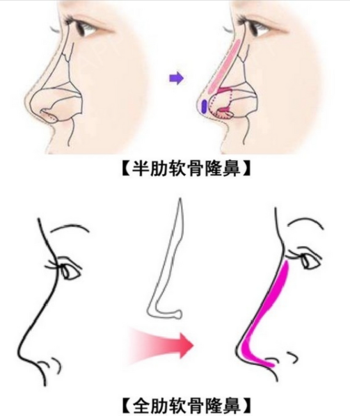 呼市隆鼻哪家好？2026最新实拍对比，告诉你如何避免馒化鼻