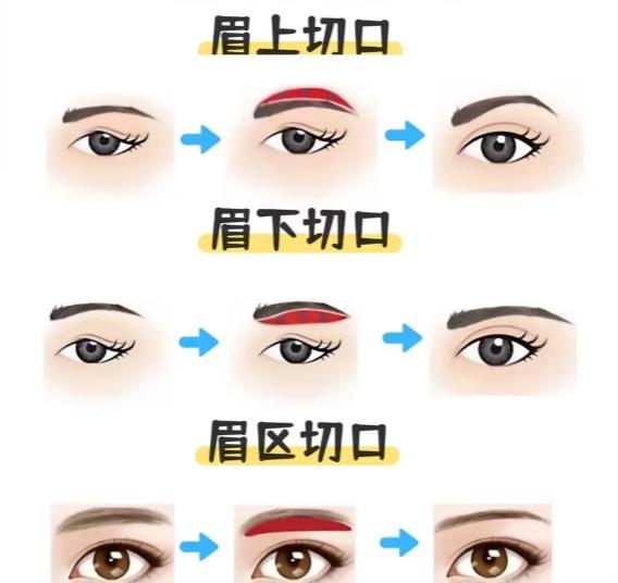 李力群医生提眉实例： 下垂眼皮终于有救了，几乎还看不出手术痕迹