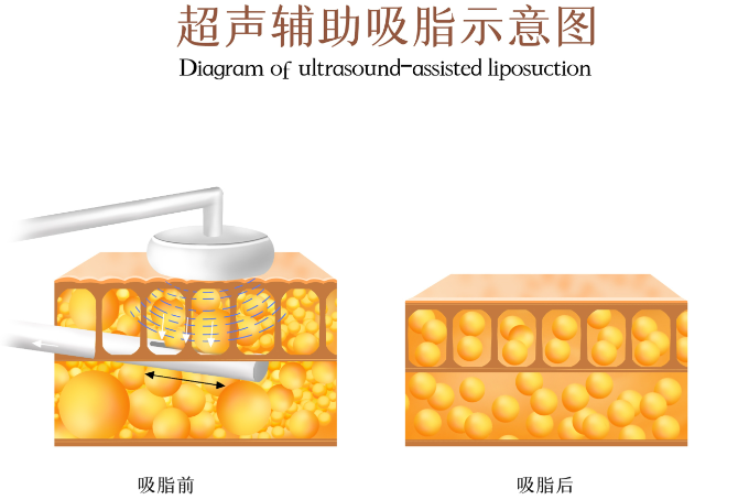 合肥抽脂需要多少钱一次？ 预算1万左右能做大腿，性价比确实挺高