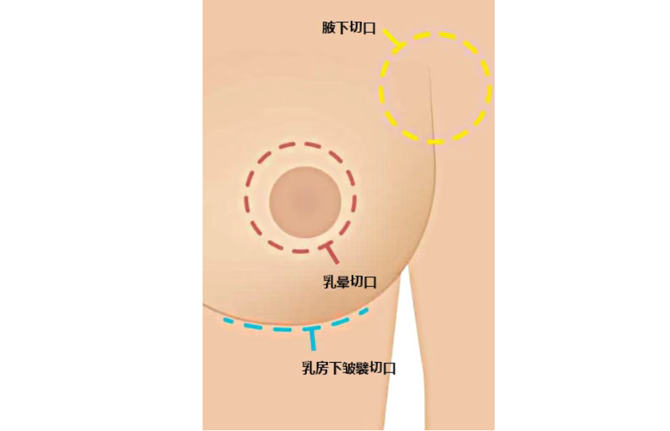 五、关于刘成胜脂肪丰胸的常见问题