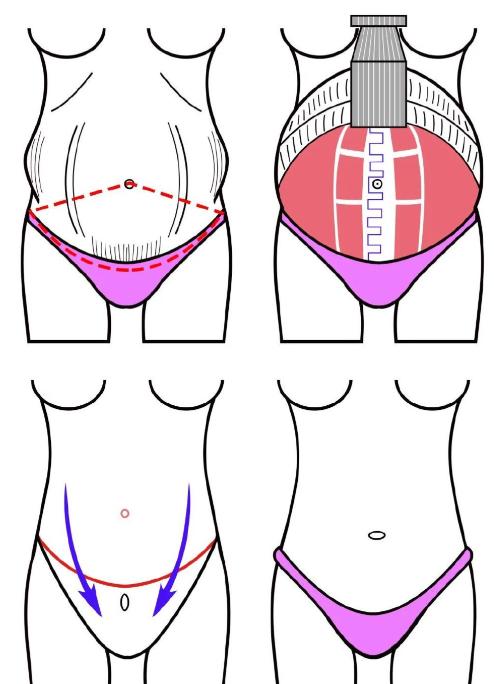 五、李鸿君腹壁成形手术常见问题解答www.aimei.com