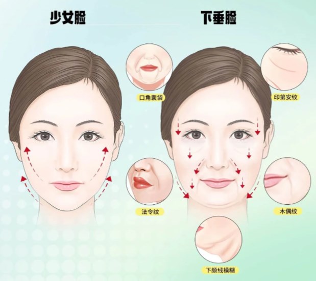 塑美极和热玛吉的区别：热玛吉适合中重度松弛，塑美极更适合预防+轻度提升