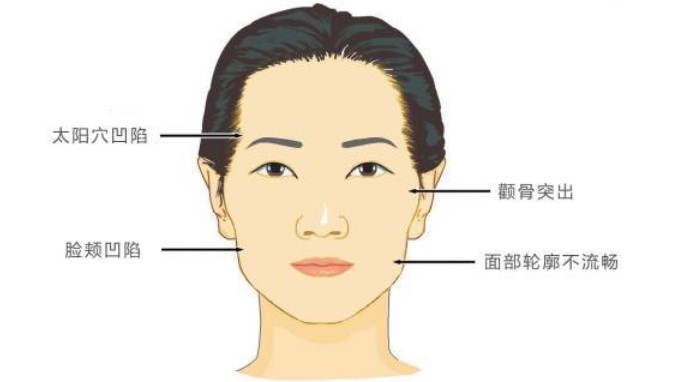 三、时艳东吸脂手术真实实例验证