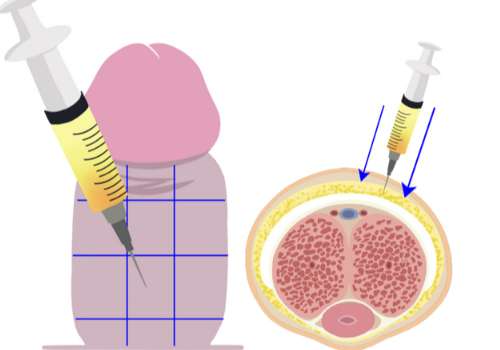 重慶劉彥龍醫(yī)生注射增粗價(jià)格多少？三明治注射法分四類，復(fù)合型4.2萬起！