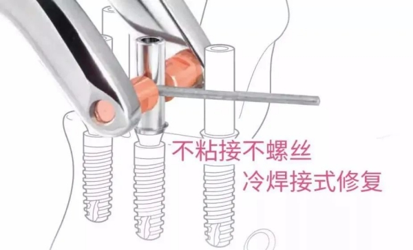 勁松口腔光華路分院種牙怎么樣？種牙正規(guī)靠譜、全程不踩坑，是勁松口腔連鎖正規(guī)分院