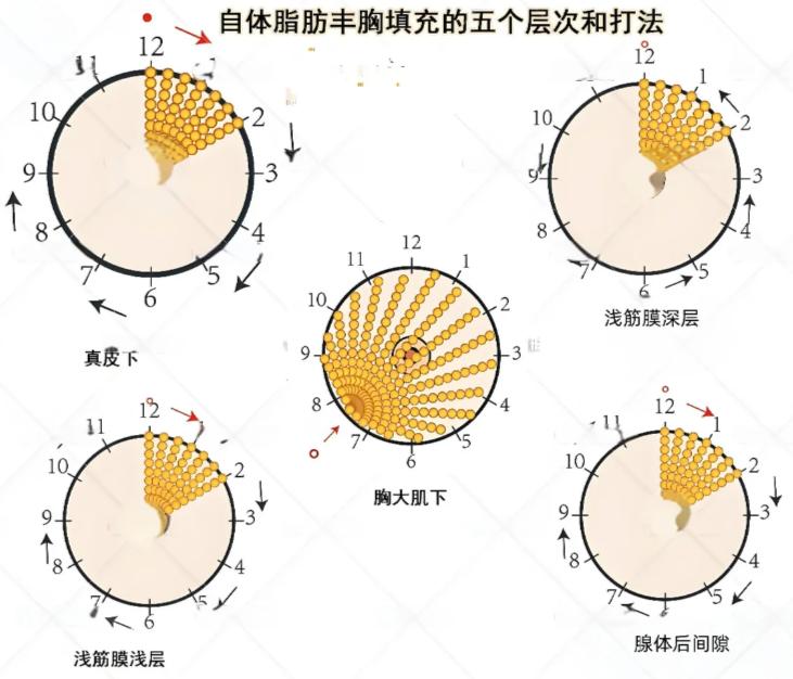 三、深圳富华唐新辉隆胸手术的五大确保