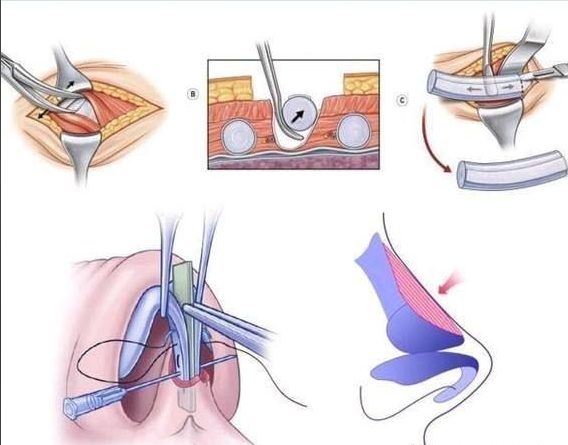 三、西安孙前磊做鼻子优势及预约攻略,轻松get理想鼻型