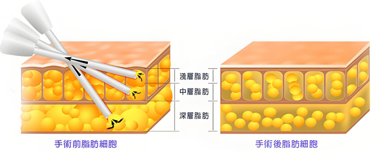 五、 問答板塊：關于武漢藝星吸脂的避坑建議