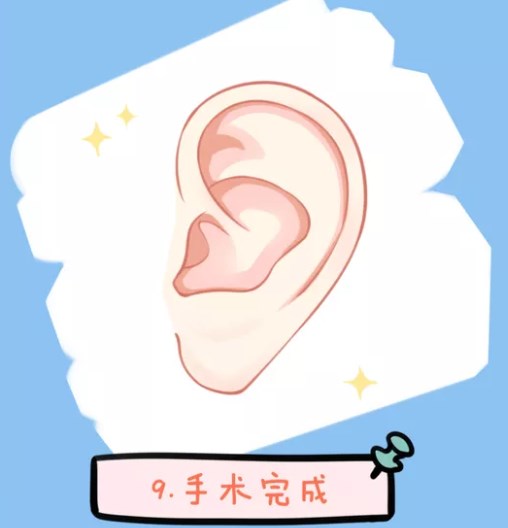 刘嘉锋主任耳朵舒展怎么样？不取肋骨不植皮！一度/二度小耳专属，术后耳朵软可压超自然！