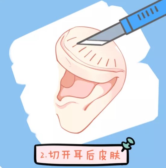 四、 找刘嘉锋医生做耳朵舒展手术的家长配合要点
