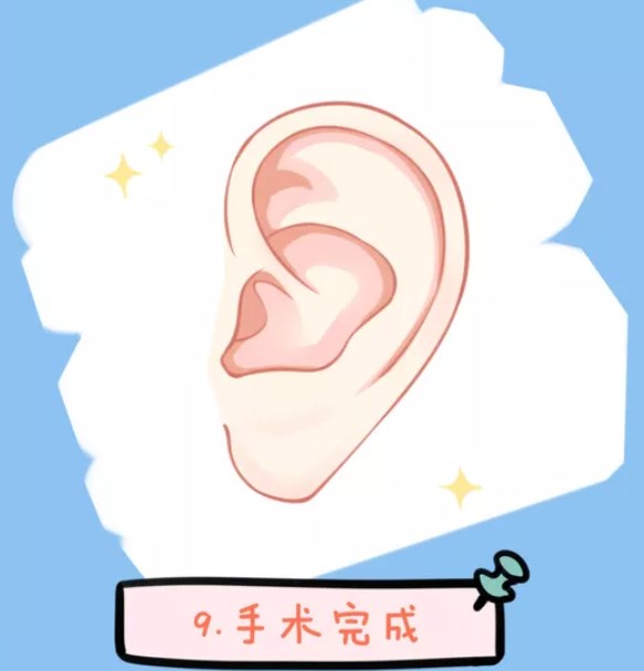 二、 刘嘉锋医生耳朵舒展对比传统肋骨耳www.aimei.com