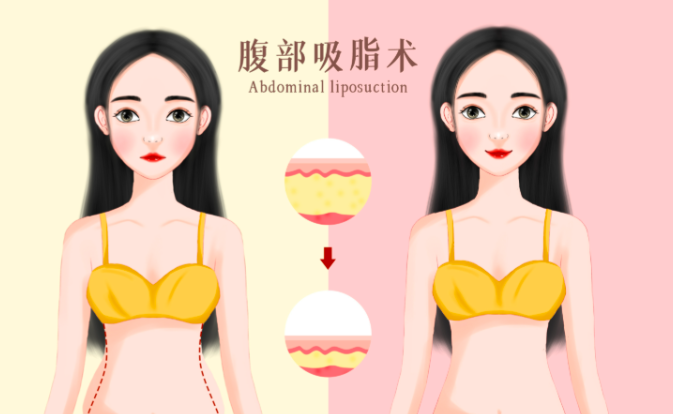 五、 关于南京陈孝闯和张让虎谁吸脂好的常见热点问答