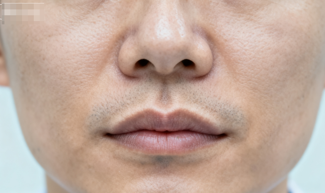 二、 在重庆橙尚找李泽医生做人中缩短到底值在哪?