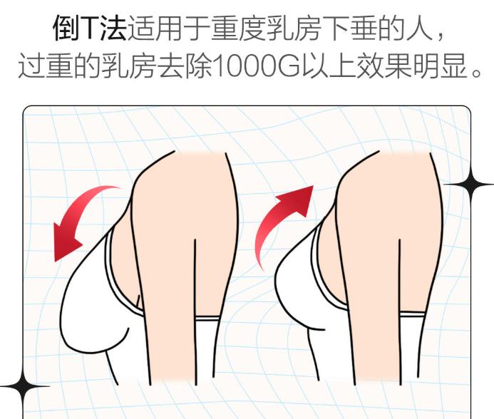 郑州徐林刚做缩胸手术怎么样？保留哺乳功能+乳头感觉！神经保护技术成熟，妈妈党也放心！