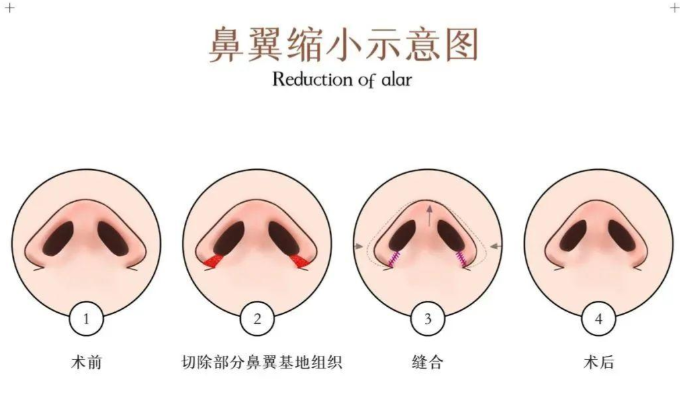四、 关于徐丽芬缩鼻翼的热点问答