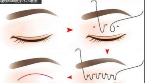 李冠英双眼皮手术价格表：2026官方完整版！附初眼/修复各档明细+技术优势+预约方式一键收藏！