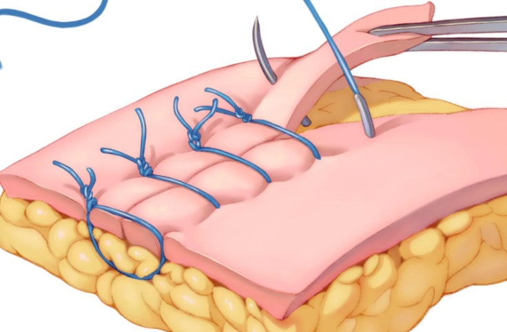 三、 避坑指南：李晓平高难鼻修复方案中的数字化可靠锁