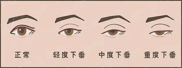 上海刘宇银口碑评价好：初眼修复都接！肉条眼/过宽疤都能救，技术稳口碑爆棚