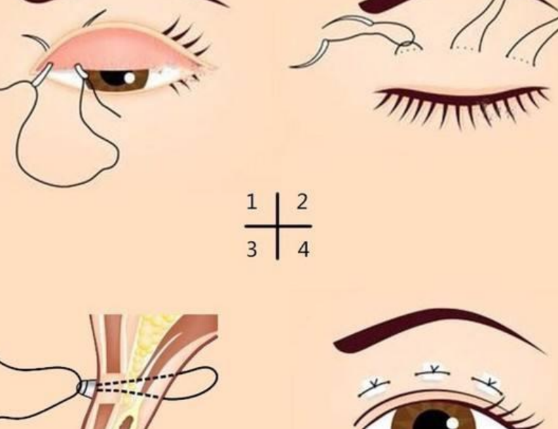 五、手术疗效与口碑评价参考www.aimei.com