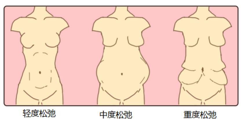 三、广州郑子良医生腹壁整形术后变好真那么快？特有“修复群”服务揭秘