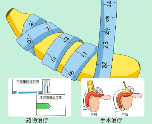 重庆星荣李世荣医生延长手术成效好