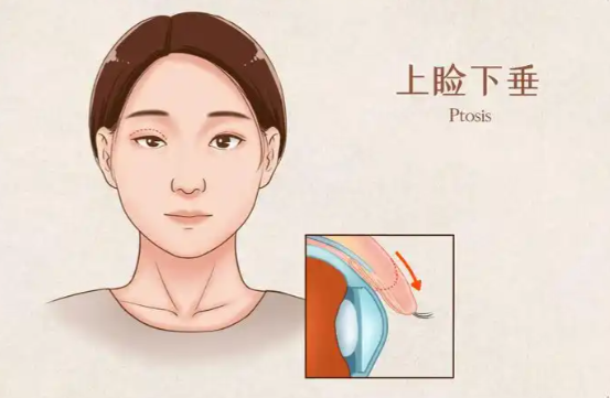 上海华美佀同帅个人简历大起底，多层组织复位技术修复肉条眼绝了，价格1.2万起