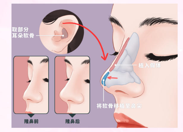 二、想找邱少琼做鼻子，到底该怎么选医院？昆明和中山美南华区别在哪？