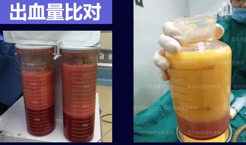 邓晟华腰腹吸脂真实案例怎么样？超生乳化技术稳得很，北京上海杭州12家私立医院靠谱盘点