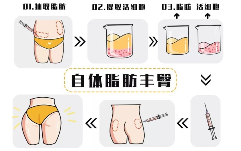 三、黄旭培臀下脂肪瓣包裹手术价格大揭秘：3万到6万，花得值不值？对比5家医院给你看