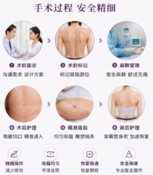 二、如何判断张艺腾医生的吸脂技术是否适合你?