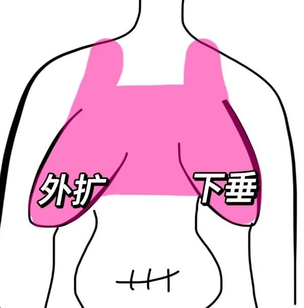 2. 术后穿着定型文胸