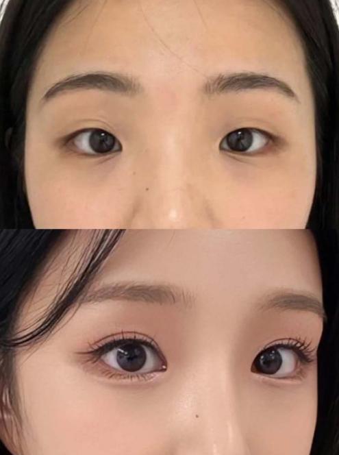 三、解读双眼皮手术:7800元起的价格与“自然风审美”内涵