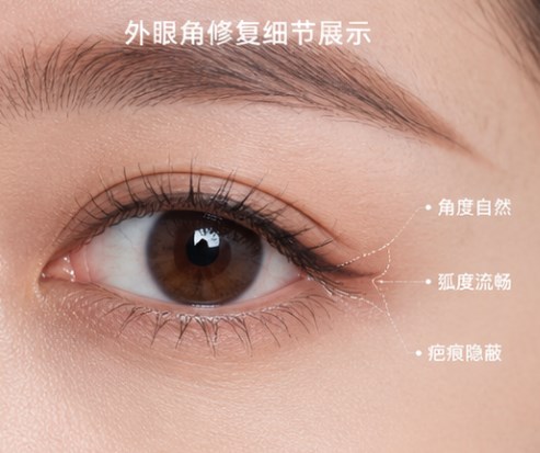 杭州黄良飞眼修复怎么样？擅长处理高难度眼修复，比如肉条、疤痕、不对称等问题