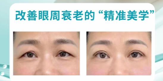 四、内窥镜提眉与其他术式对比：找到较适合你的方案