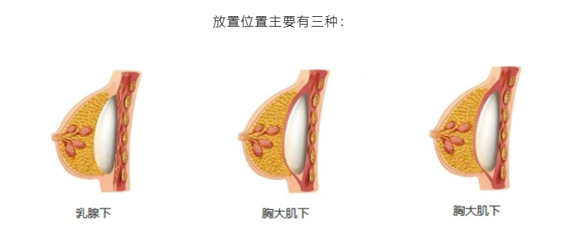 关于脂肪丰胸一次能大几个罩杯,用户最常问的几个问题(FAQ)