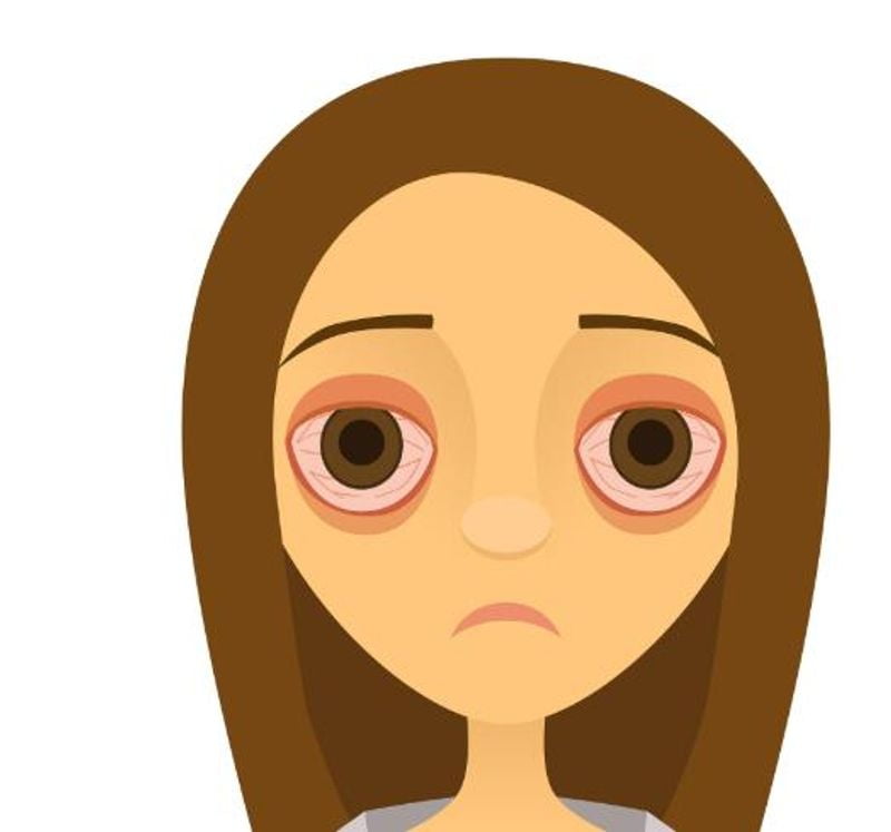 二、别光看滤镜图!技术稳在哪?剖析卢医生的“肿眼泡全切”核心操作